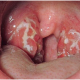biểu hiện của bệnh lậu ở miệng